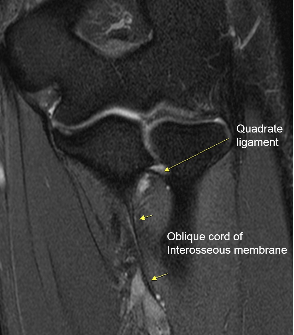 Figure 1 for case Quadrate ligament of elbow ( RID2051 )